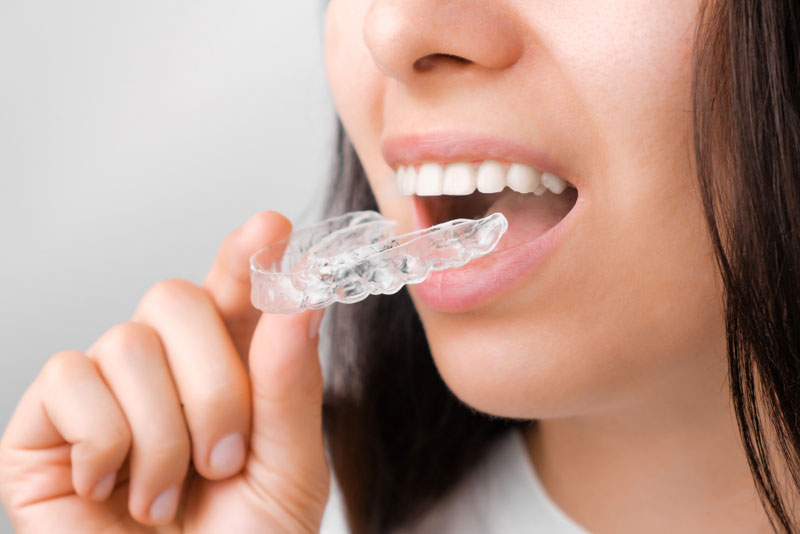 How Invisible Braces Can Help You Confidently Smile Again!
